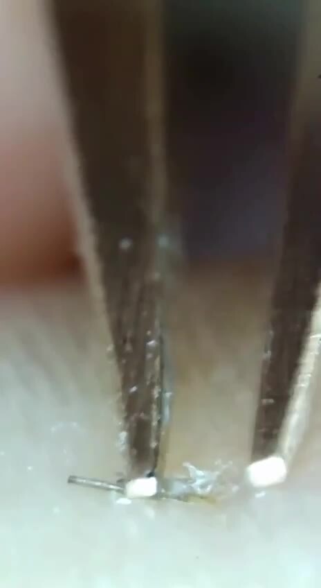 Удаление вросшего волоса | Numezar, 09 марта 2023