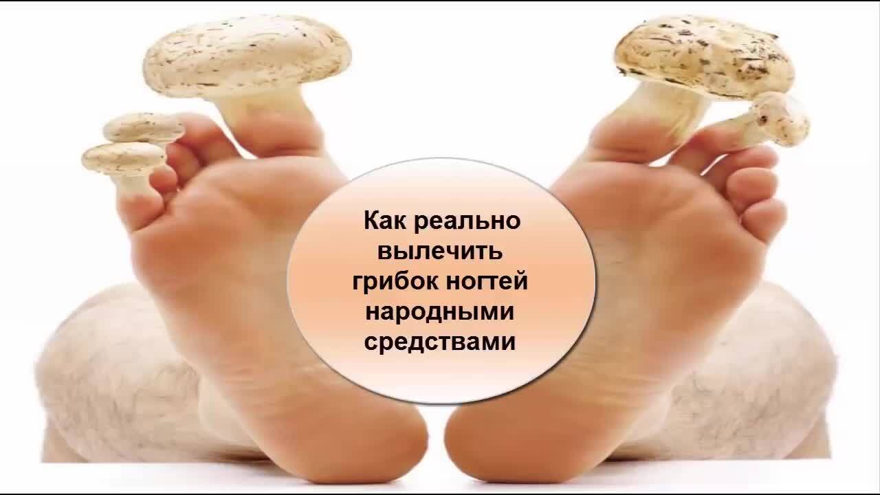 Как вылечить грибок ногтей народными средствами